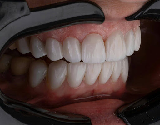 Invisalign