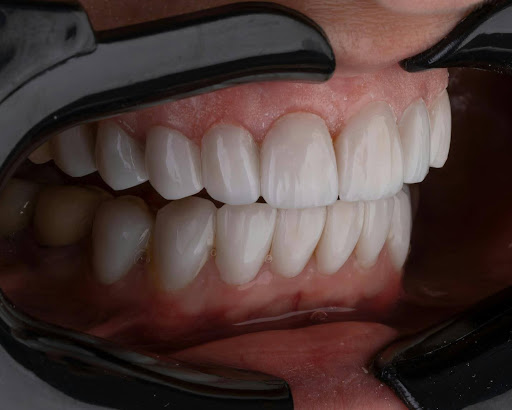 Invisalign