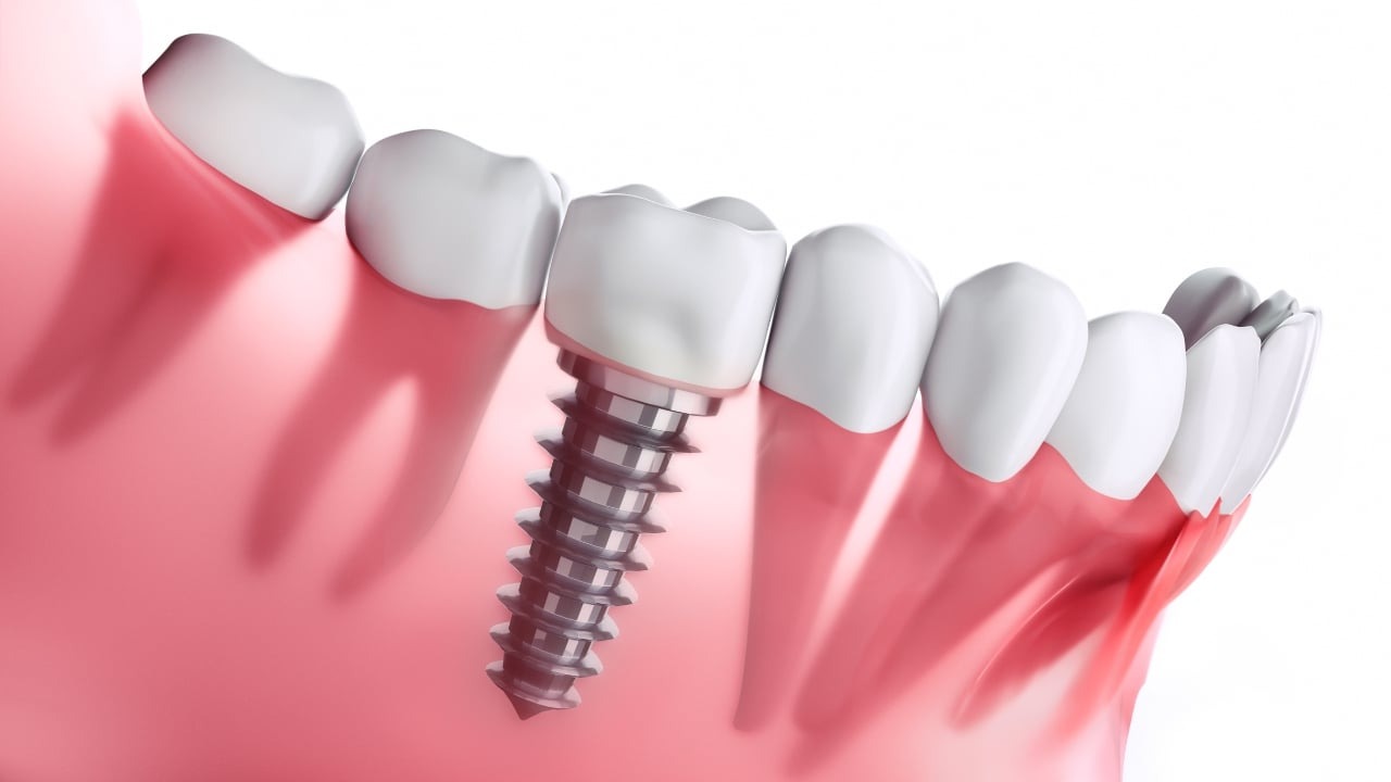 Dental Implant in Korea Everything You Need to Know